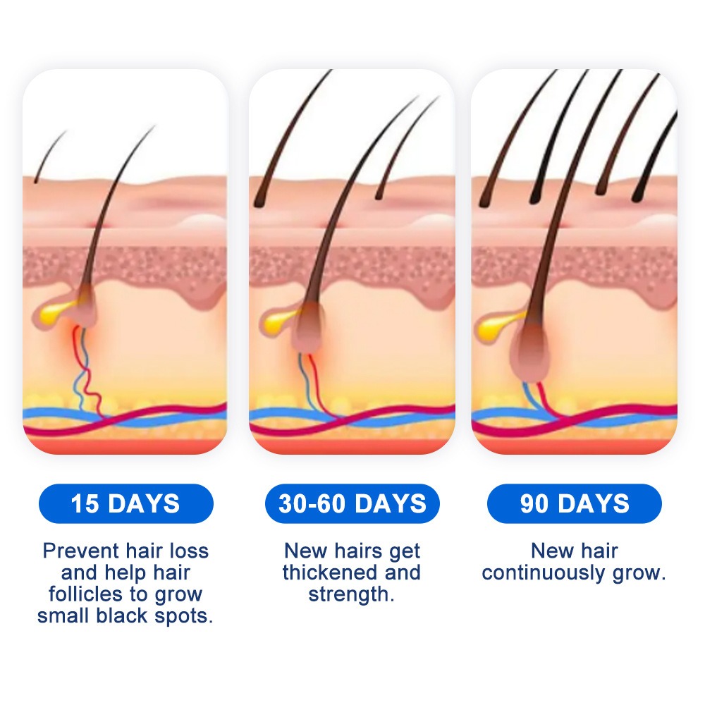 Alopecia Spray de croissance d - Hair Care For Hair Growth avis et prix